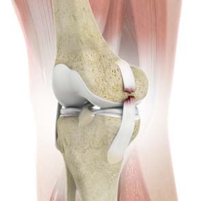 Collateral Ligament (MCL / LCL) Tear/Reconstruction